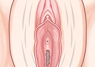 수술 전 대음순