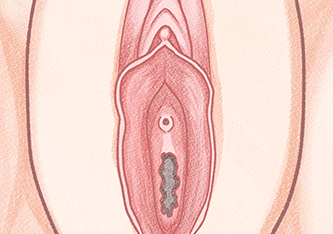 수술 후 대음순