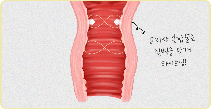 프리샤산부인과의 섬세한 봉합술